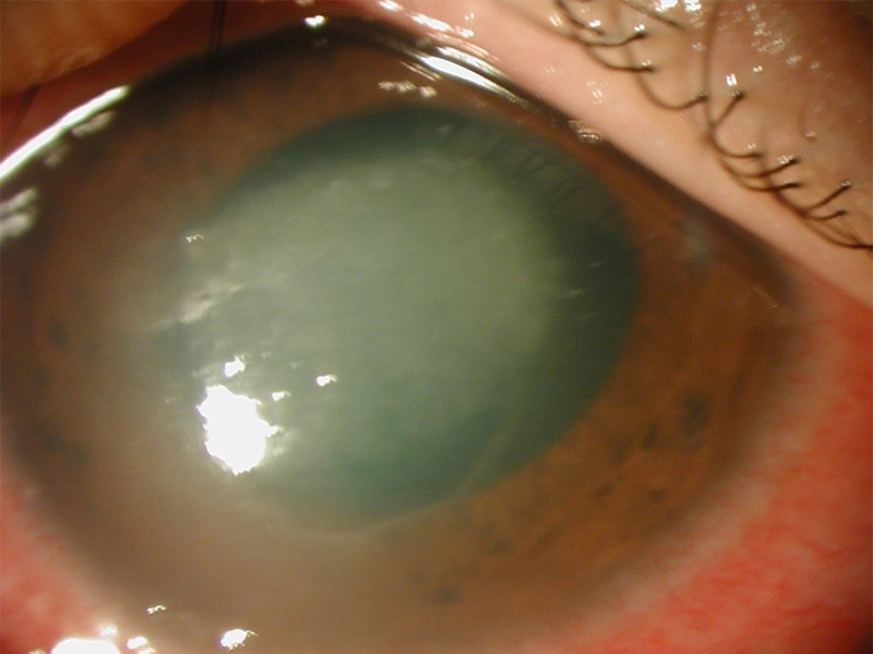 不適切な使用によるアメーバ感染